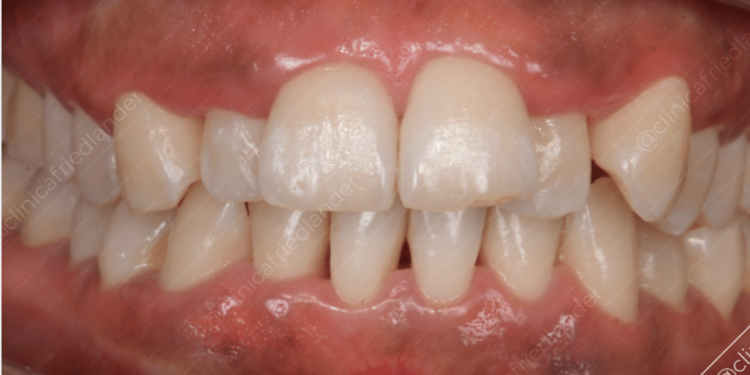 ¿Tiene relación la inflamación de las encías con el Alzheimer?